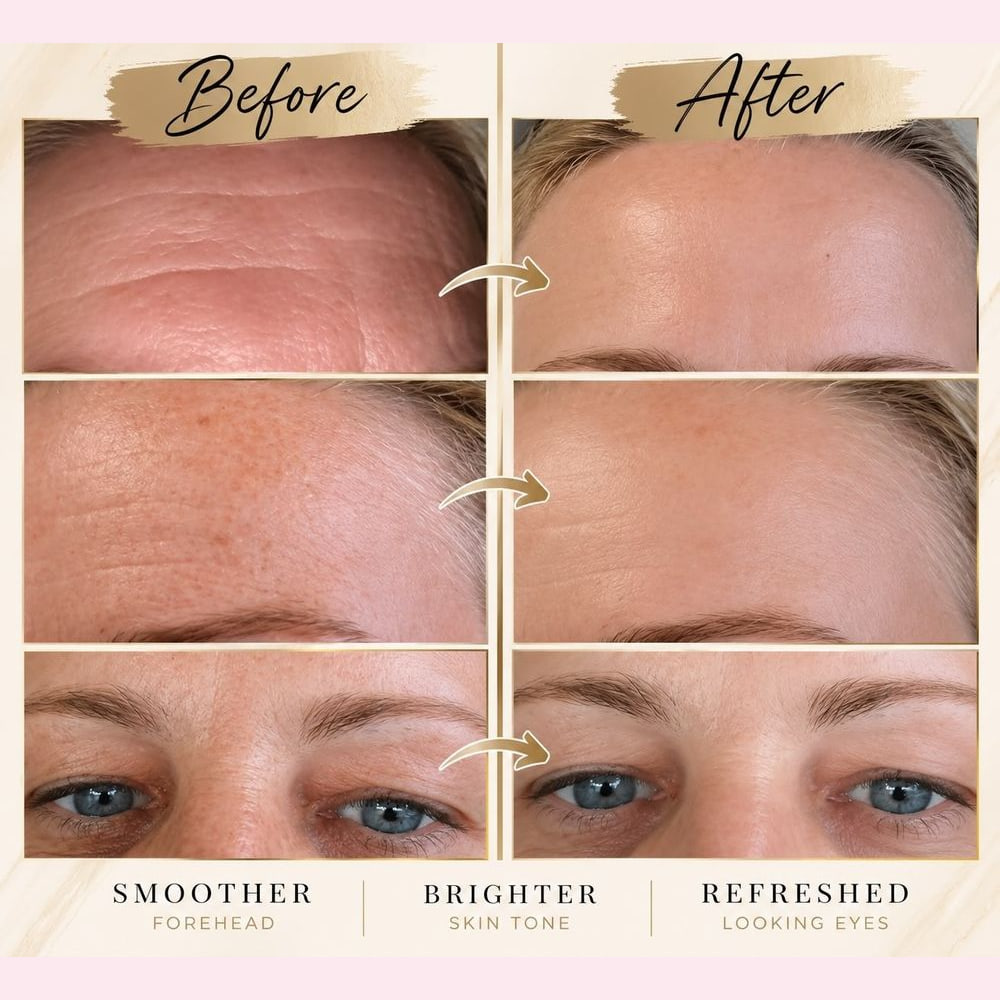 Three before-and-after pairs showing a smoother forehead, brighter skin tone and a refreshed eye area after anti-wrinkle treatment