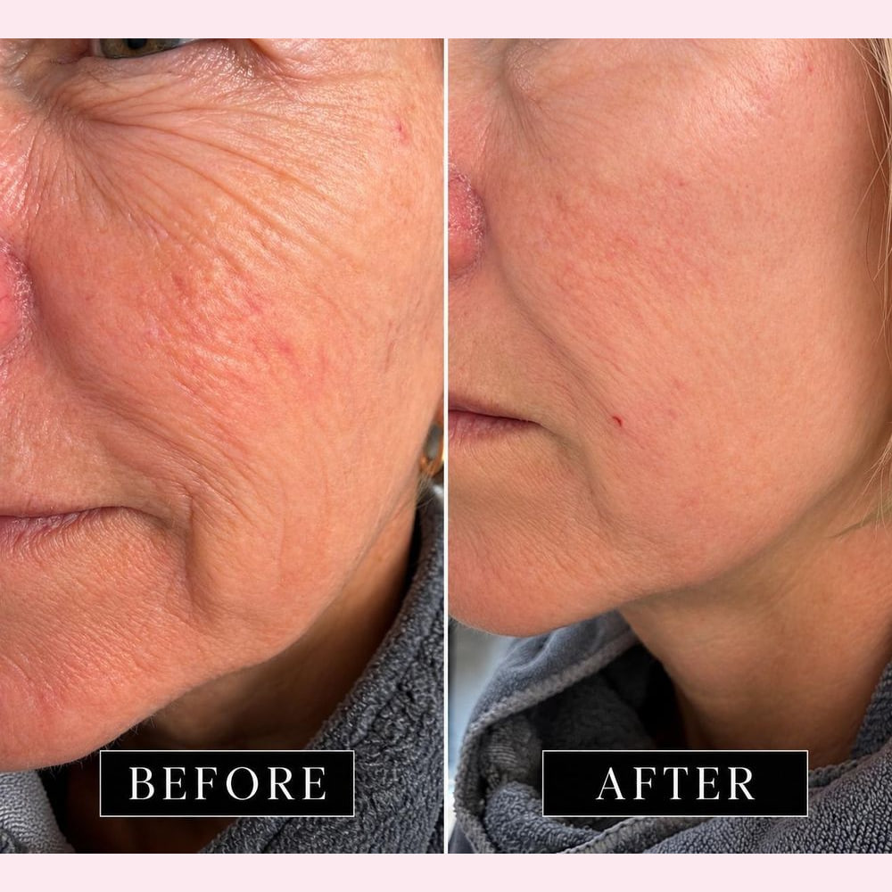 The cheek and jawline photographed before and after a dermal filler appointment