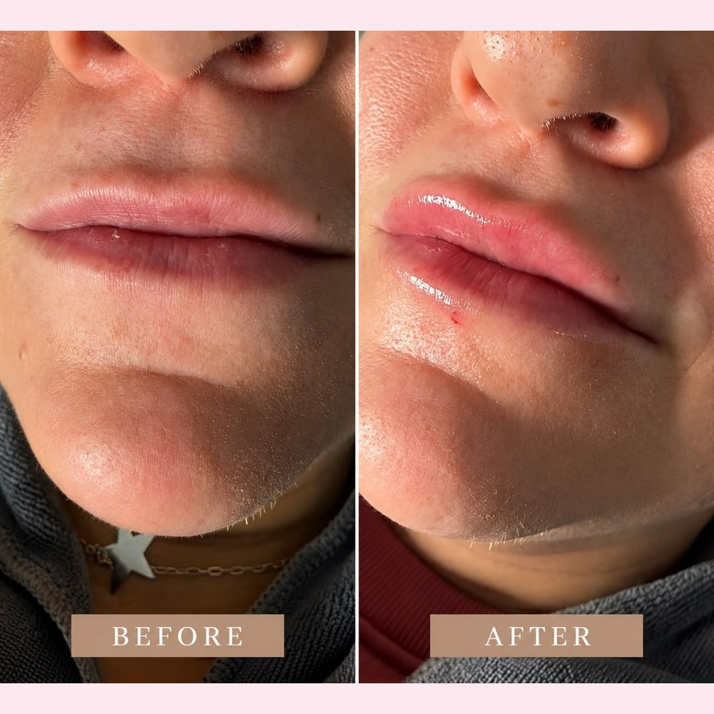 Lips photographed before and after a lip filler appointment