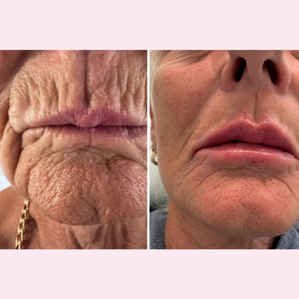 Lips photographed before and after treatment, with the fine lines around the mouth much softer
