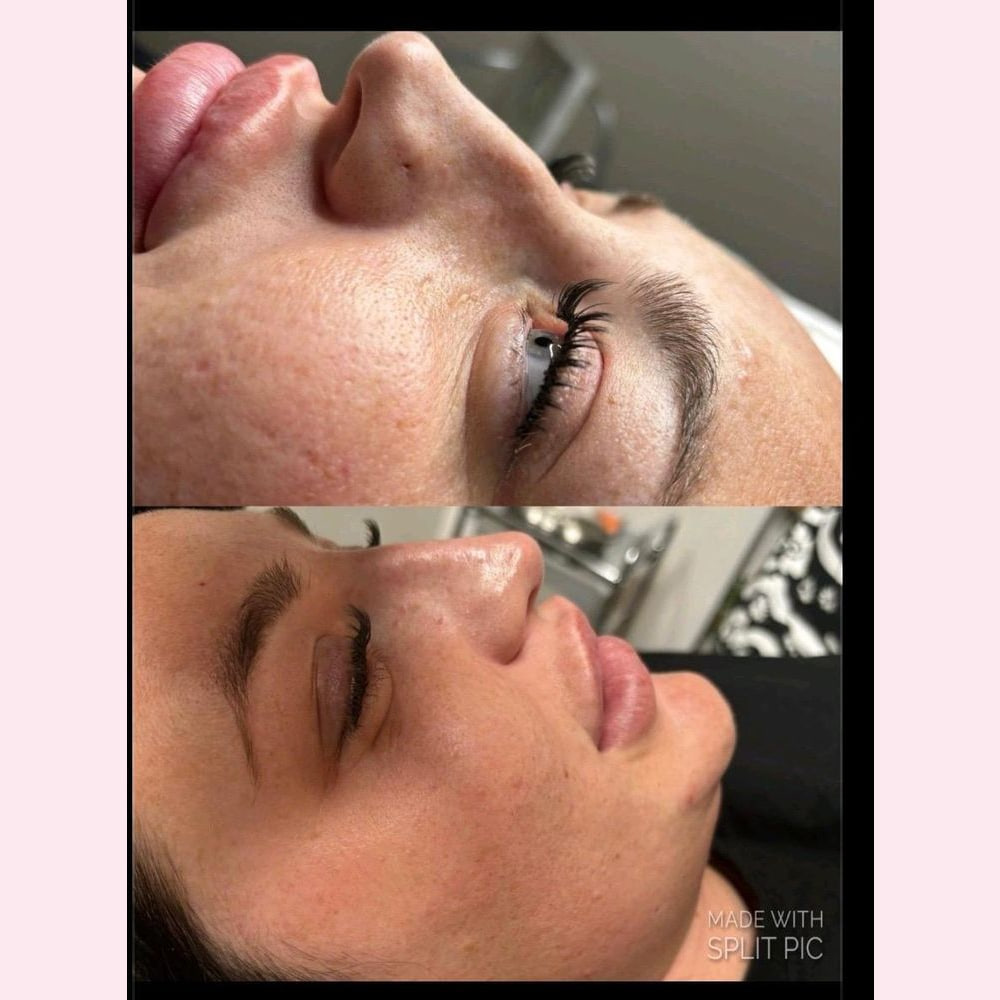 A profile photographed before and after a nose filler appointment