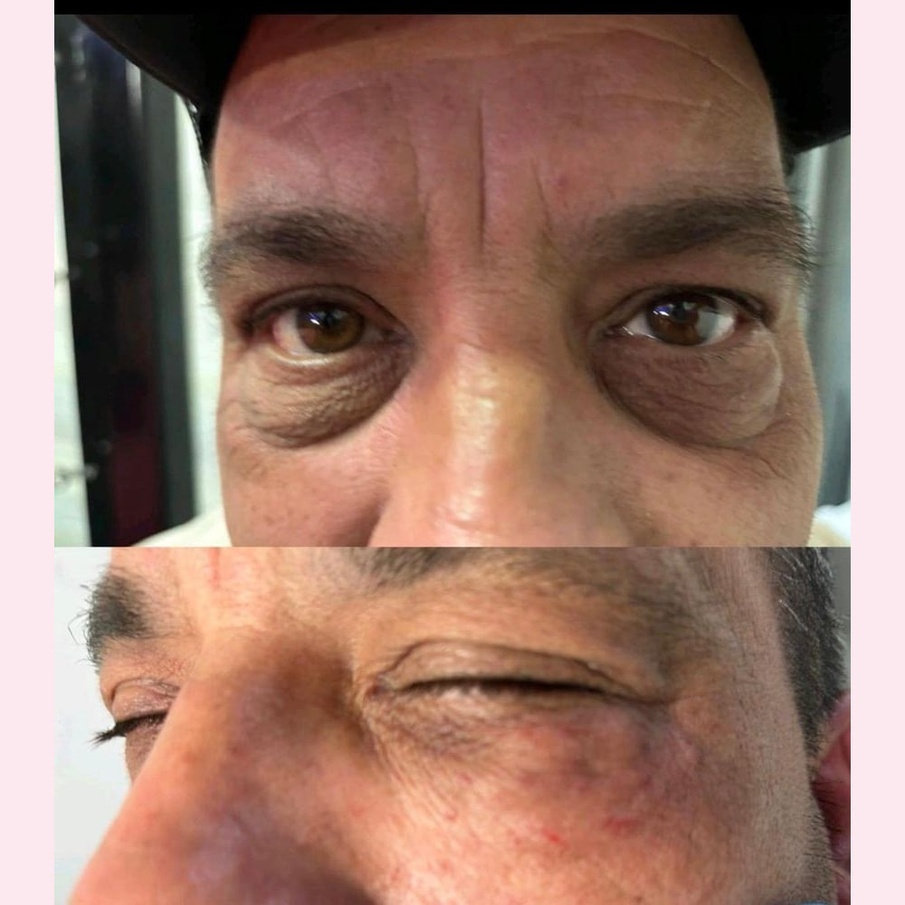 The eye area photographed before and after an under-eye skin booster appointment